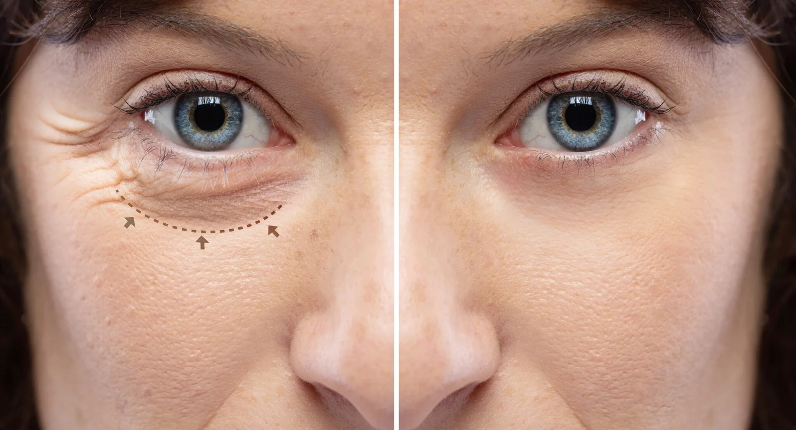 Anti-Wrinkle Injections